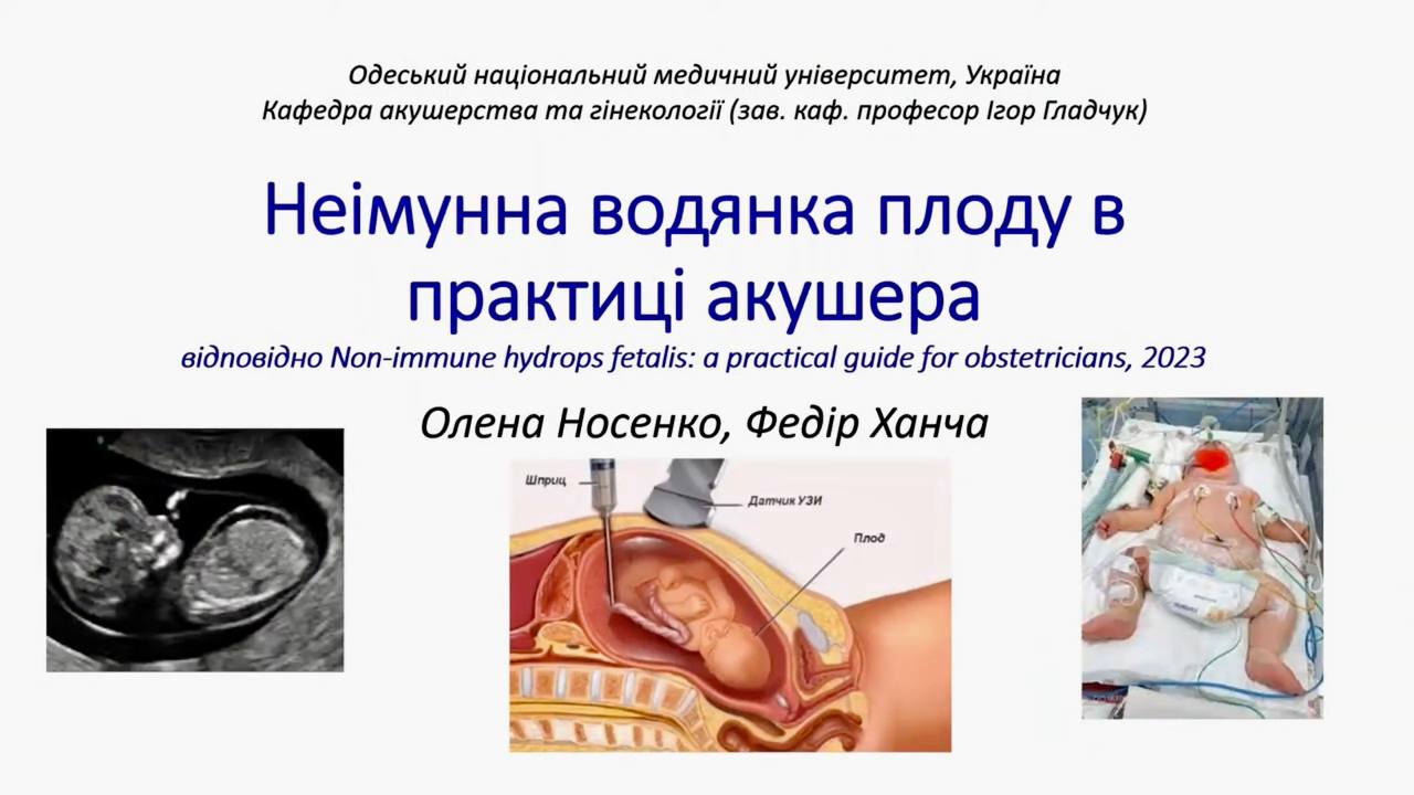 Presentation on non-immune hydrops fetalis in obstetric practice